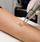 Pico Laser vs Older Tattoo Removal Lasers: What's the Difference?
