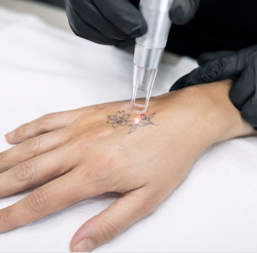 How Many Sessions Does Laser Tattoo Removal Take?