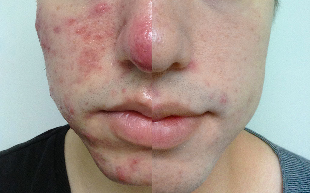 Client Stories - Acne Results - Sean