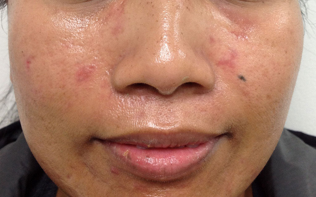 Acne Dark Skin - After Treatment Perth K|B Karen Bowen Skin Clinic