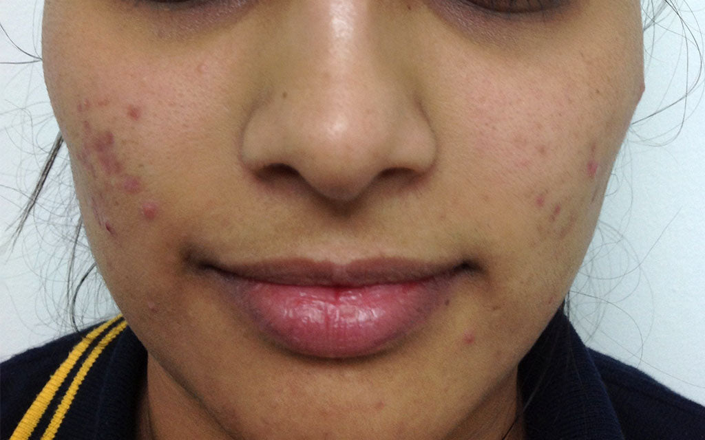 Acne Treatment 002 - Front - Before Karen Bowen Skin Clinic Perth