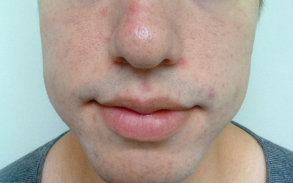 DMK Acne Treatment 006 - Front - After Karen Bowen Skin Clinic Perth