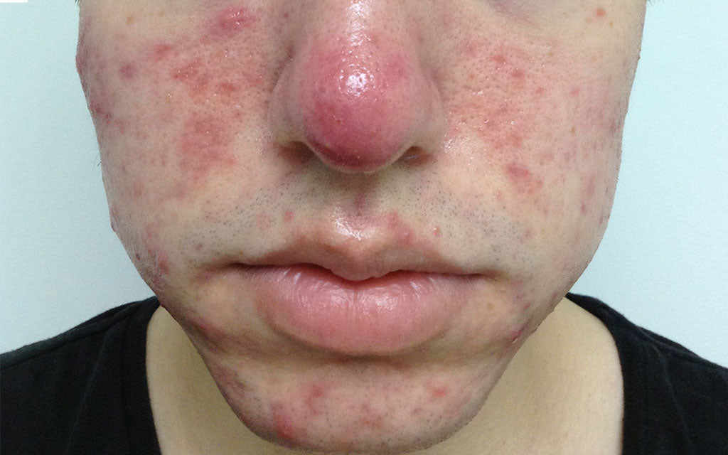 DMK Acne Treatment 006 - Front - Before Karen Bowen Skin Clinic Perth