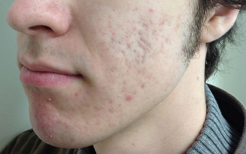 Acne Scarring Results 007 - Left - After Treatment Karen Bowen Skin Clinic Perth