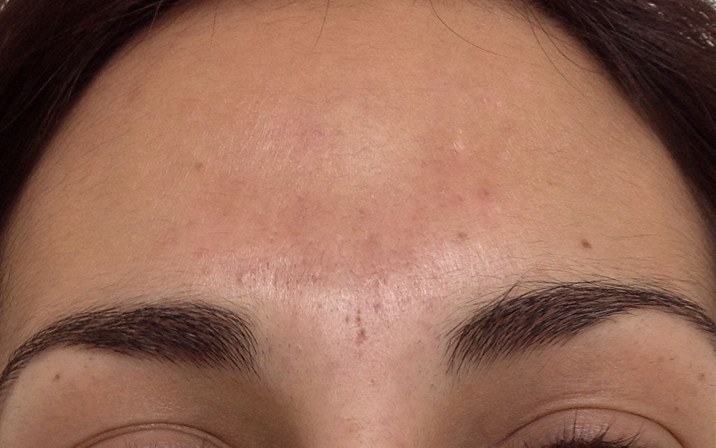 Acne Treatment 005 - Front - After - Karen Bowen Skin Clinic Perth