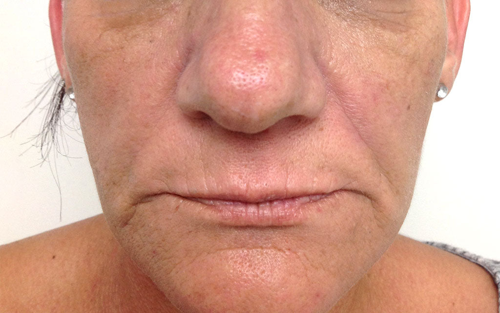 Aging Skin Treatment 001 - Front - After Karen Bowen Skin Clinic Perth