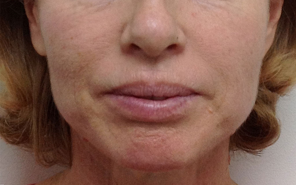Aging Skin Treatment 004 - Front - Before Karen Bowen Skin Clinic Perth