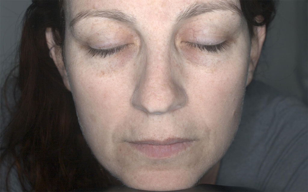 IPL Perth - Pigmentation Treatment 001 - Front - After Karen Bowen Skin Clinic IPL Perth