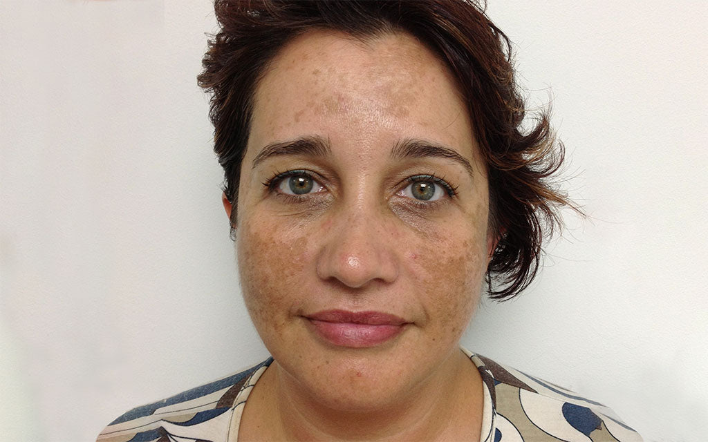 Pigmentation Treatment 002 - Front - Before Karen Bowen Skin Clinic Perth