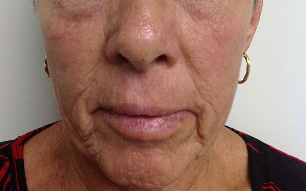 Pigmentation Treatment 004 - Front - After Karen Bowen Skin Clinic Perth