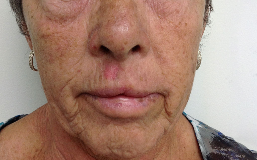 Pigmentation Treatment 004 - Front - Before Karen Bowen Skin Clinic Perth