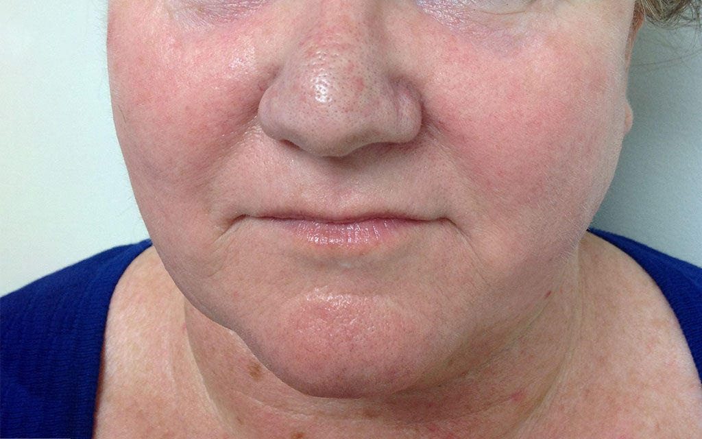Rosacea Treatment 001 - Front - After Karen Bowen Skin Clinic Perth