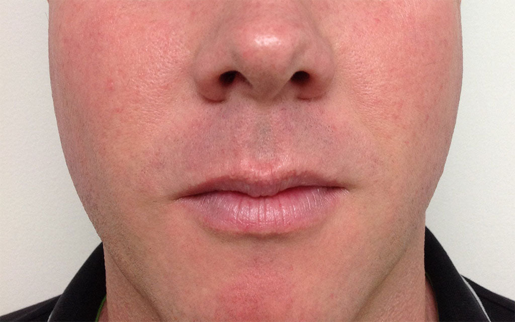 Rosacea Treatment 005 - Front - After Karen Bowen Skin Clinic Perth