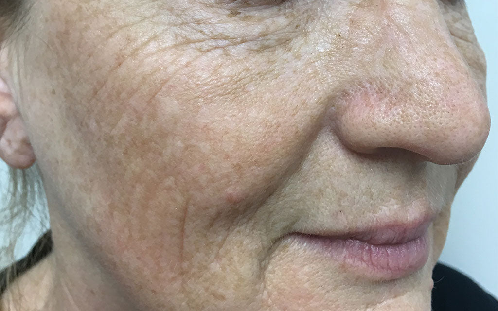 Wrinkles and Pigmentation Results 001 - Right - Before Treatment Karen Bowen Skin Clinic Perth